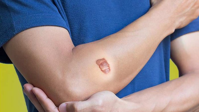 Keloid Di Kulitmu Mengganggu? Ini 4 Cara Untuk Mengatasinya Secara Permanen!