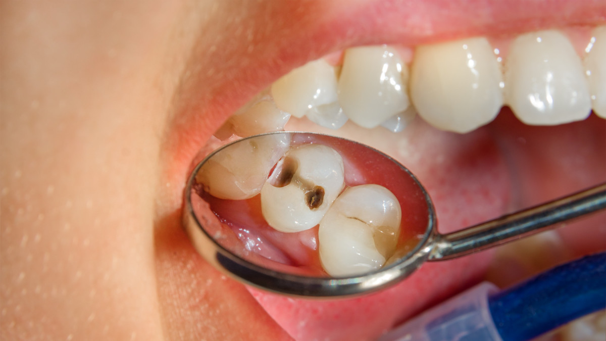 Waspada! Kamu Harus Tau, Inilah Penyebab dan Cara Mengatasi Sakit Gigi yang tak Kunjung Sembuh 