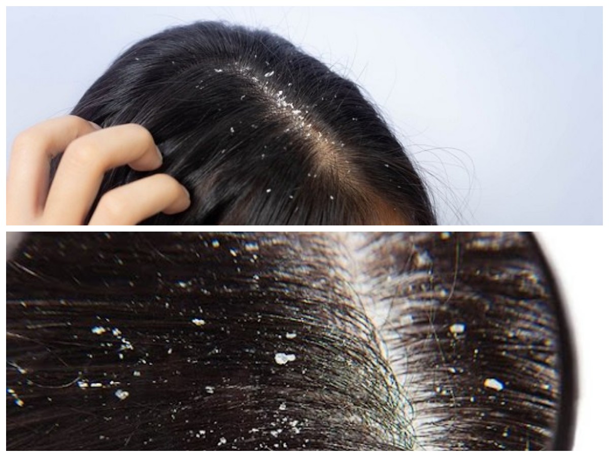 Atasi Ketombe dengan Mudah: Tips dan Perawatan untuk Rambut Sehat Tanpa Gangguan