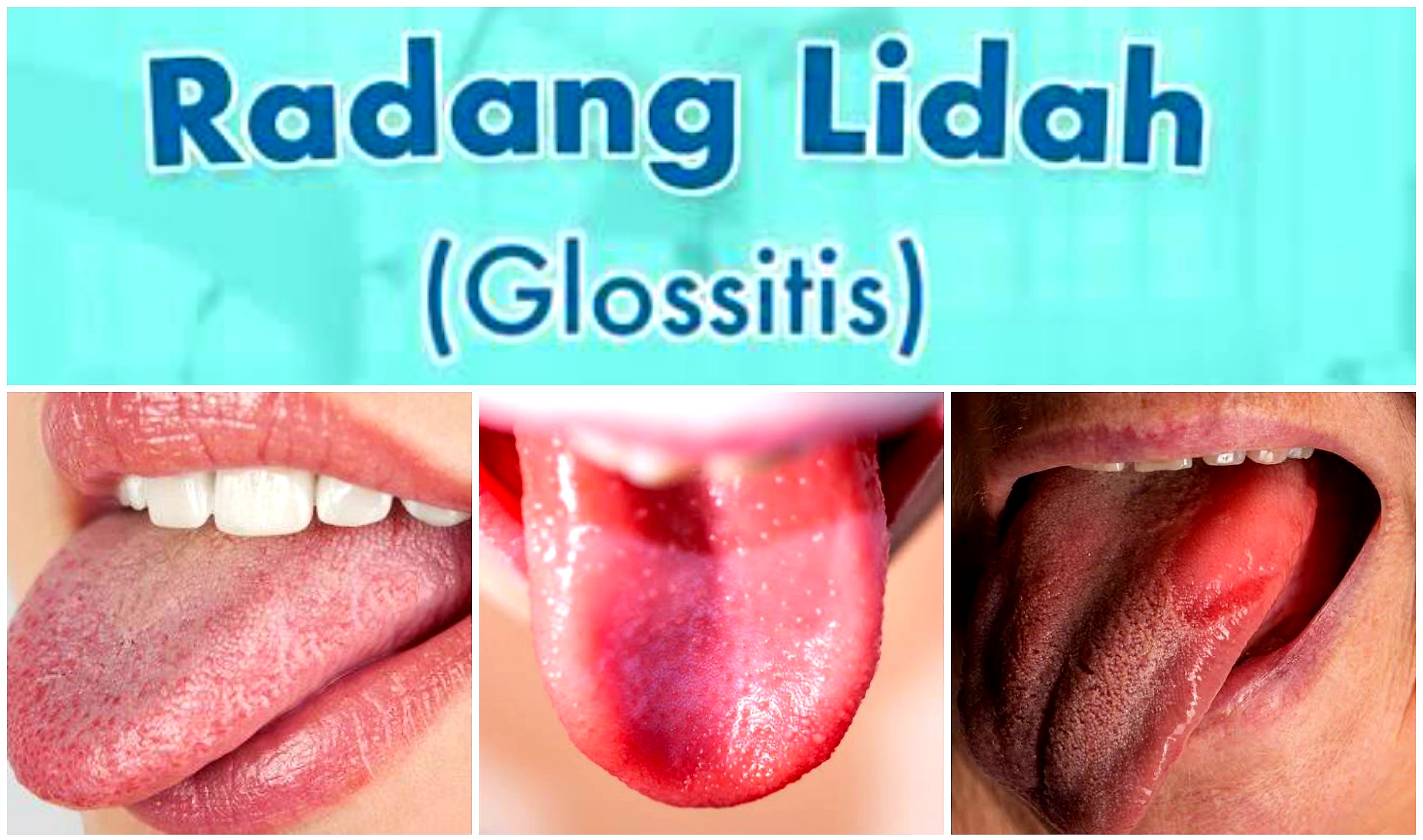Penanganan Tepat Radang Lidah atau Glositis