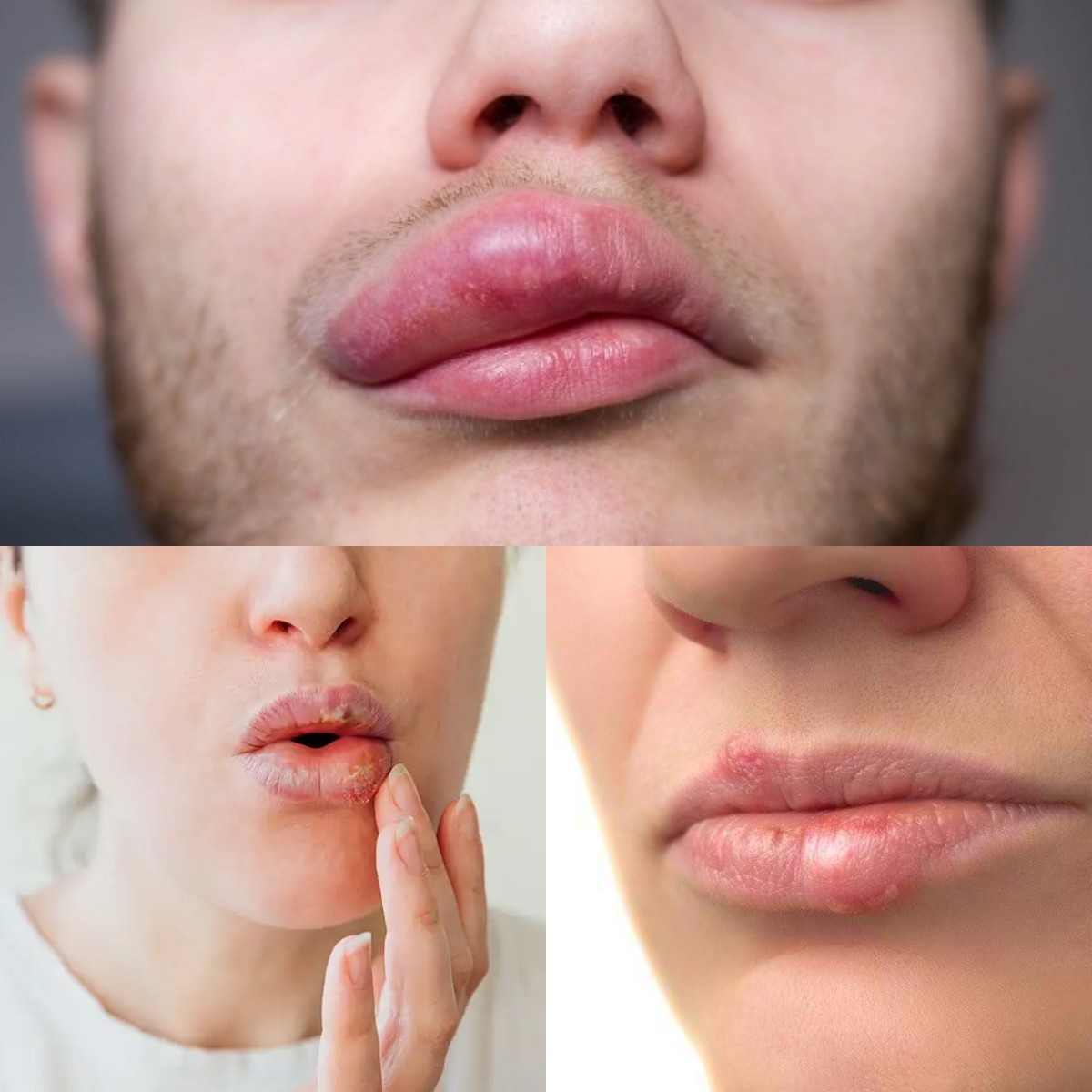 Penyebab BibirBengkak Umumnya tidak Berbahaya, Tips Mengatasinya!