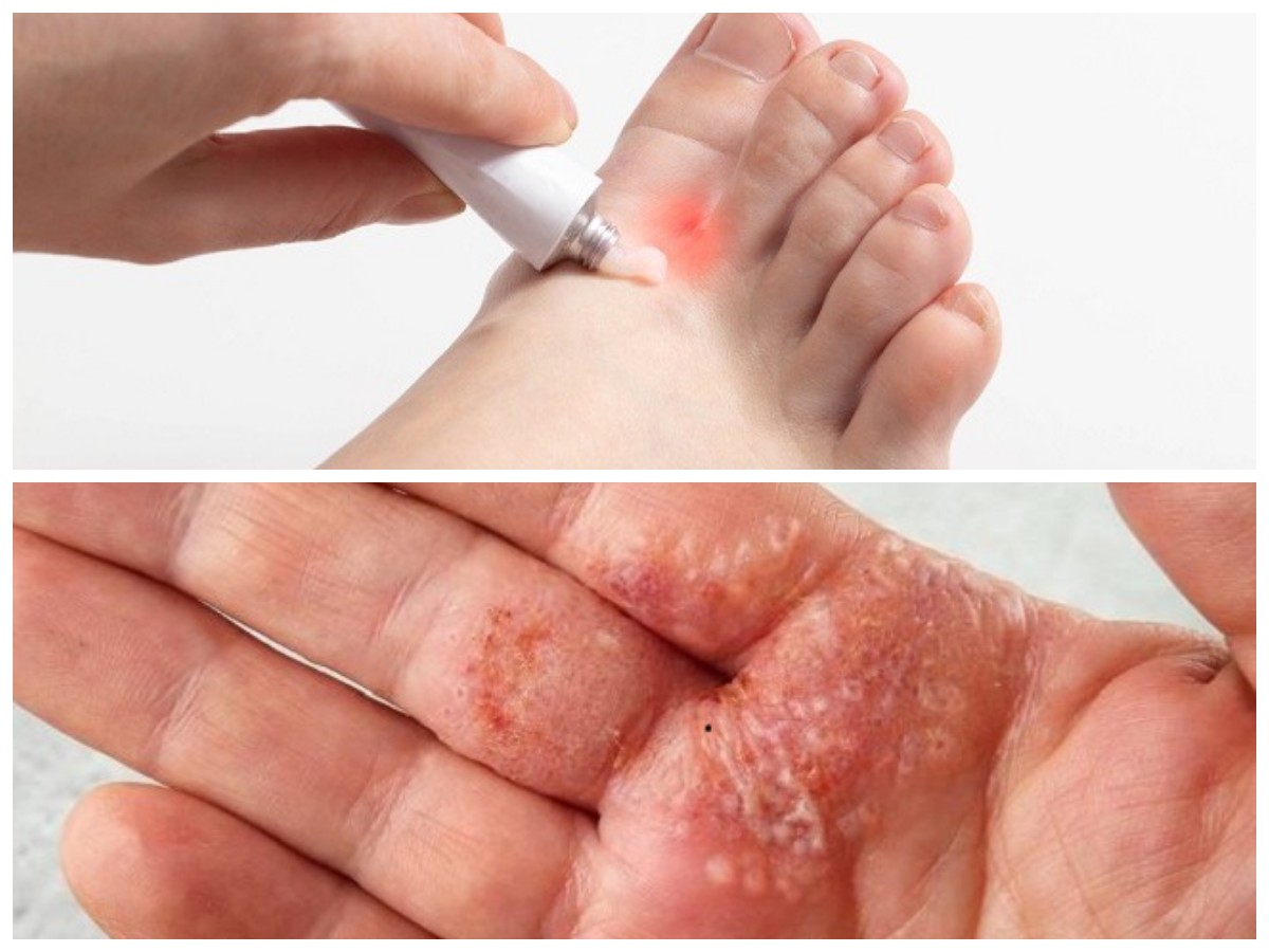 Panduan Lengkap Mengobati Kutu Air dan Strategi Pencegahan Efektif