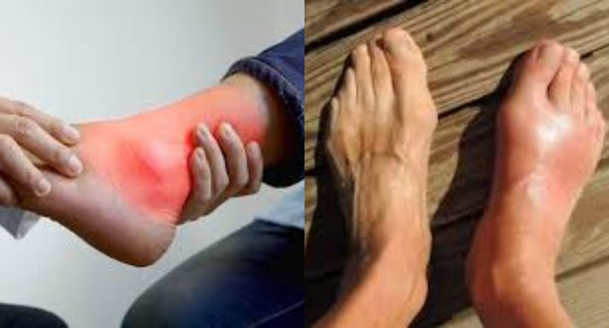  Sering Tidak Disadari! Kenali Tanda-Tanda Asam Urat, Penyebab dan Cara Mengobatinya