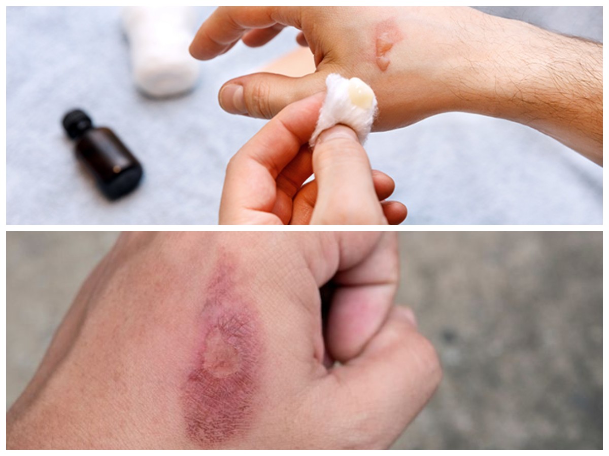 Cara Tepat Merawat Luka Bakar: Langkah Aman agar Cepat Sembuh dan Tidak Berbekas