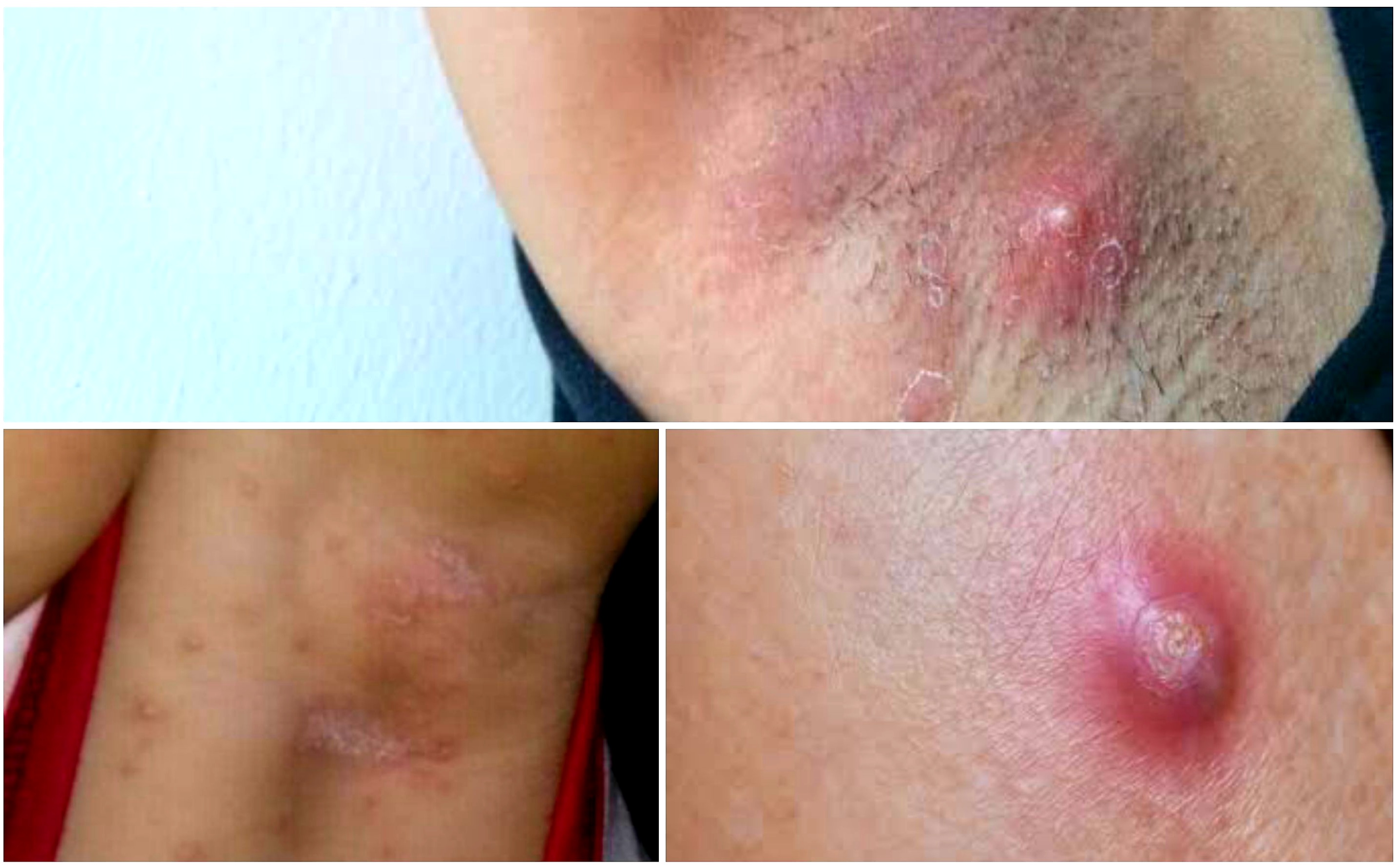 Ganggu Aktivitas. Ini Cara Atasi Bisul di Ketiak dengan Obat Rumah