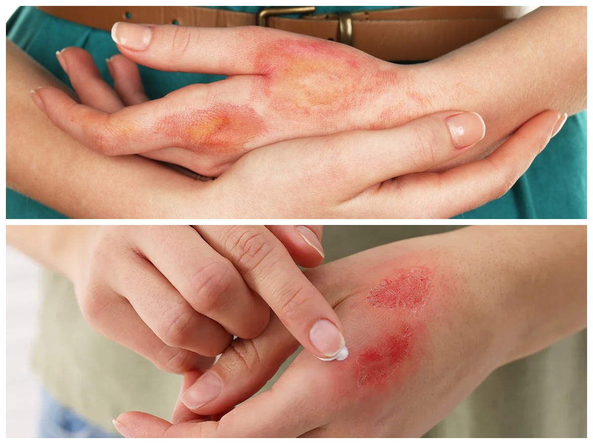 Panduan Perawatan Luka Bakar: Tips Efektif Mencegah Infeksi dan Mempercepat Pemulihan