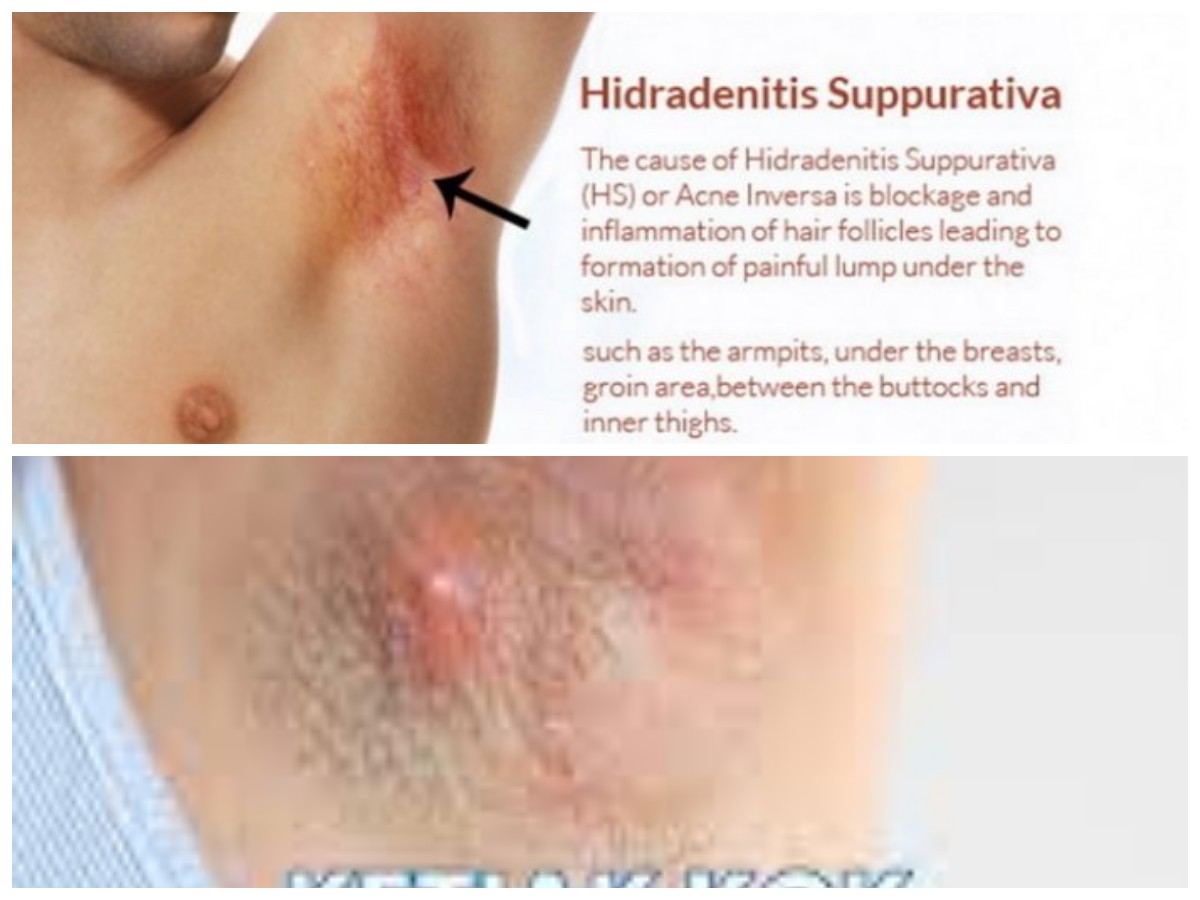 Faktor Penyebab Bisul di Ketiak dan Tips Efektif untuk Menyembuhkannya