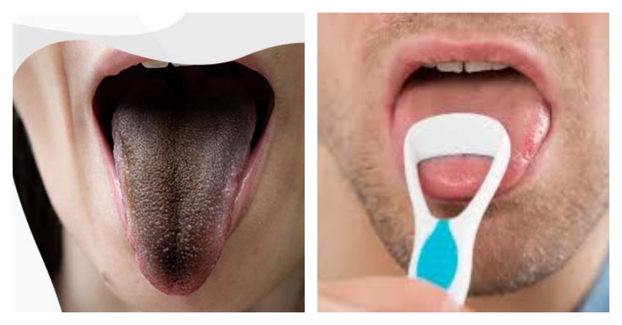 5 Penyebab Lidah Tampak Hitam dan Berbulu