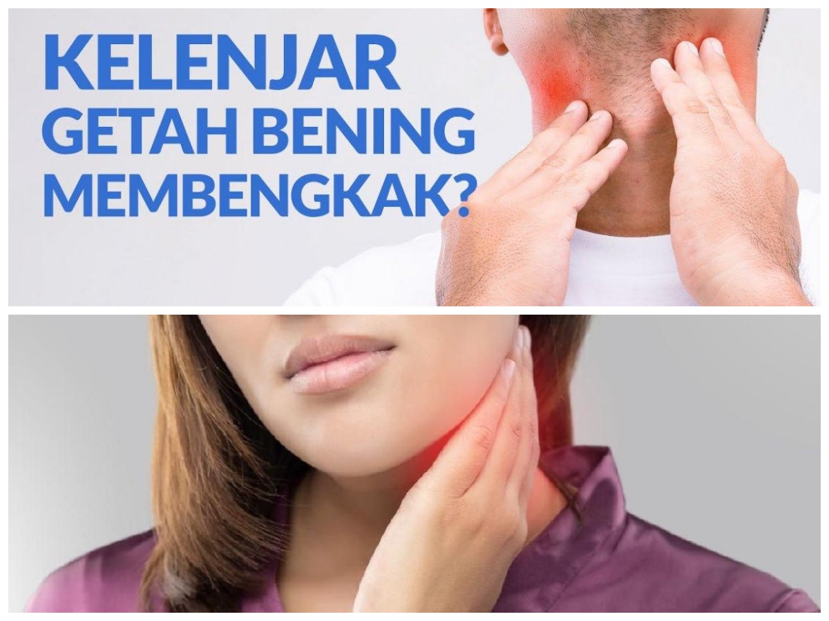 Cara Efektif Mengobati dan Meredakan Pembengkakan Kelenjar Getah Bening di Rumah