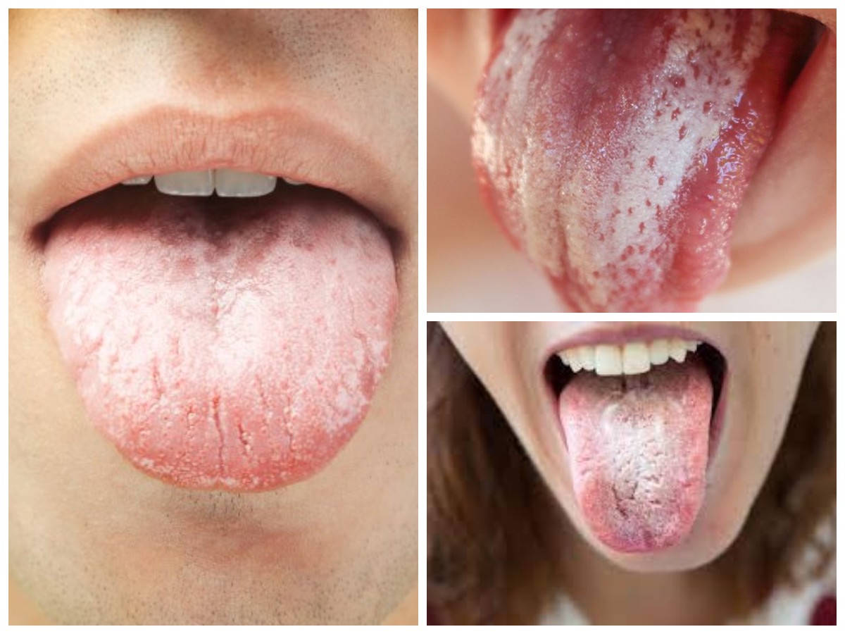 Kenapa Lidah Berwarna Putih? Kenali Penyebab dan Cara Mengatasinya!