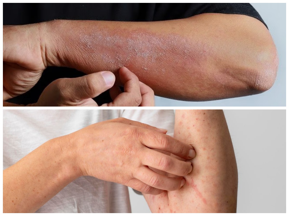 Jangan Diabaikan, Ini 8 Penyebab Kulit Kering dan Gatal yang Berkaitan dengan Kesehatan