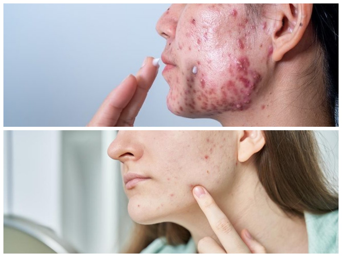 Cara Ampuh Menghilangkan Jerawat Batu dengan 7 Langkah Praktis