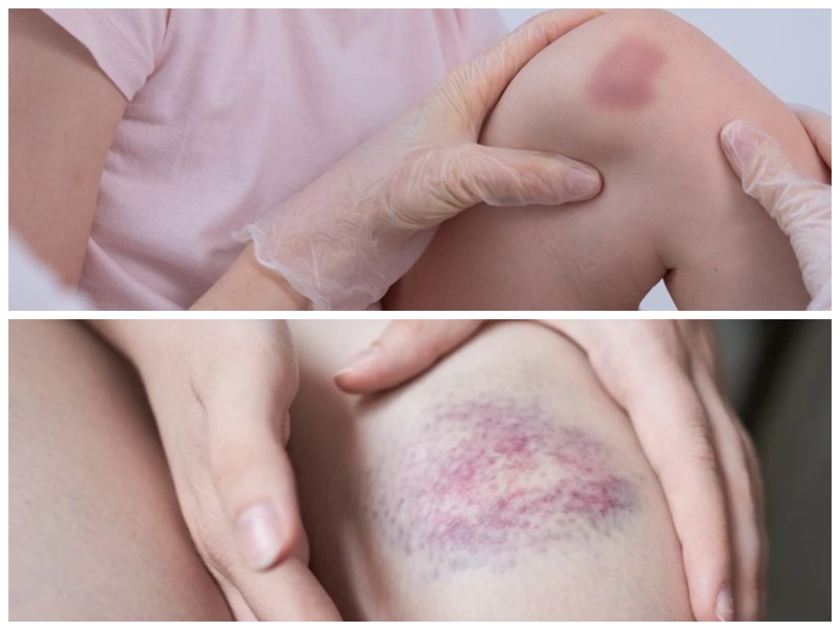 Memahami Luka Memar: Dari Penyebab hingga Tanda-Tanda Pemulihan