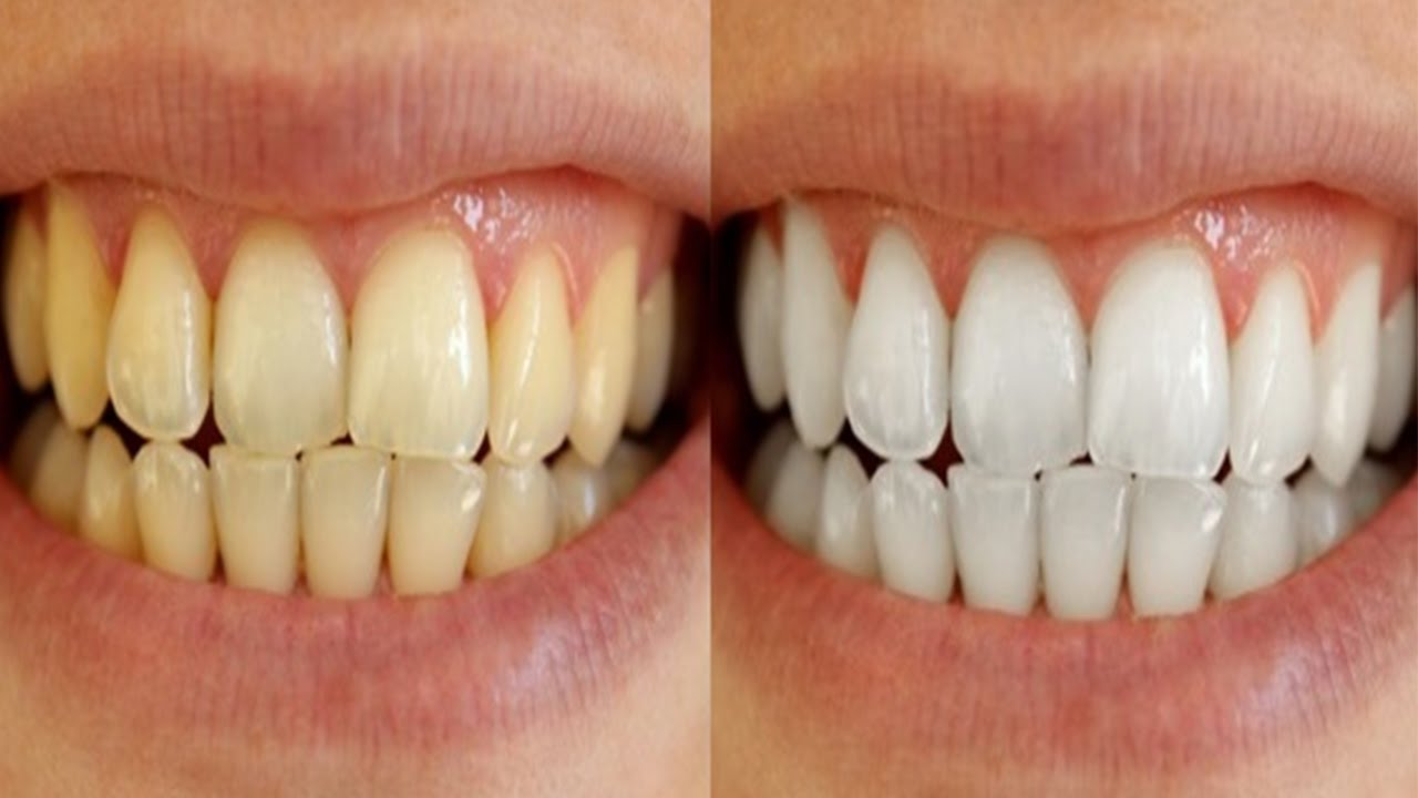 Selamat Tinggal Gigi Kuning! 5 Bahan Alami Ini Ampuh Putihkan Gigi