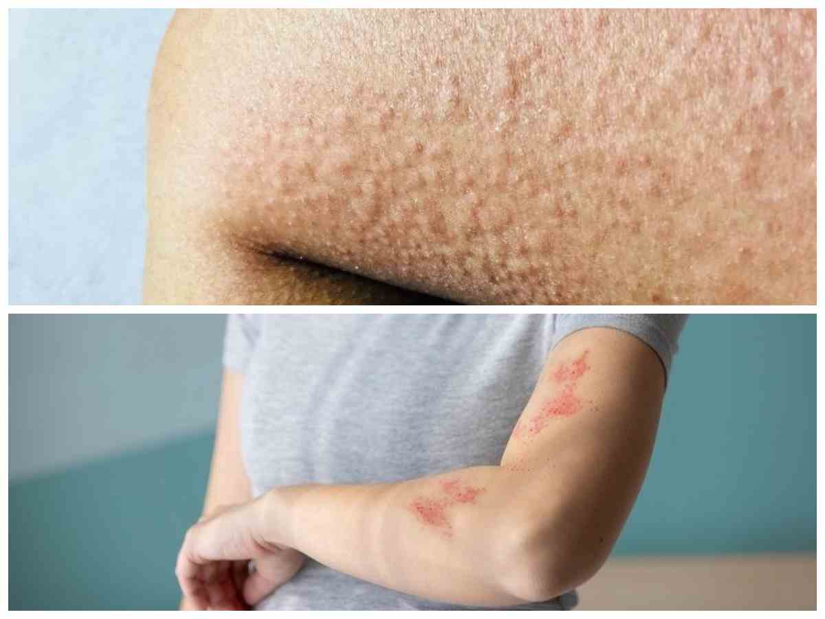 Jangan Panik! Ini 5 Solusi Efektif untuk Mengatasi Alergi Dingin dan Debu