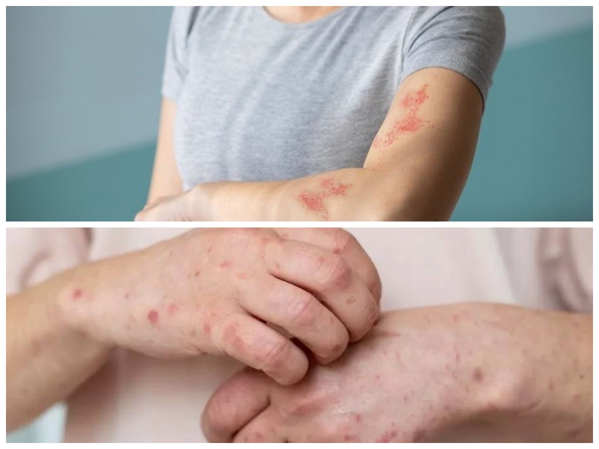 Alergi Bikin Tak Nyaman? Coba 5 Tips Jitu Atasi Dingin dan Debu Ini!