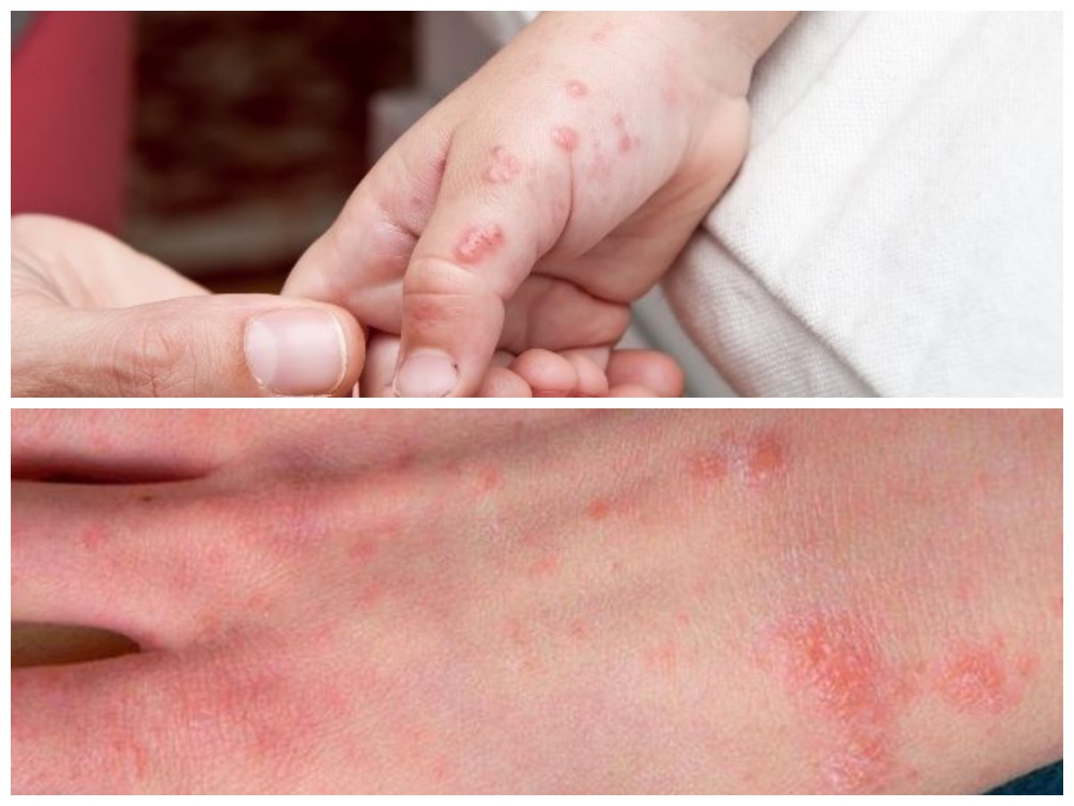 Kulit Terinfeksi Bakteri? Ini 5 Jenis Umum dan Cara Efektif Mengatasinya