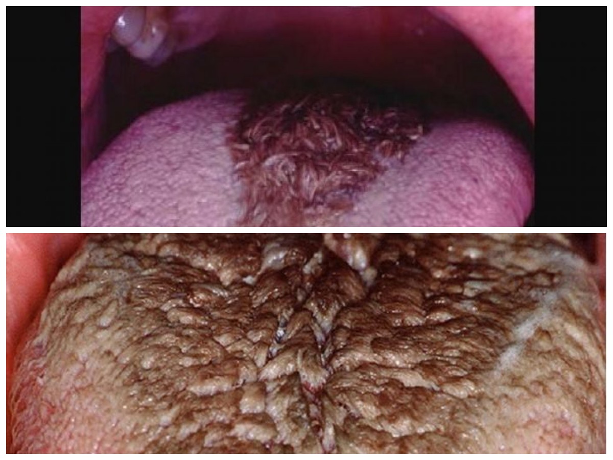 Kenapa Lidah Bisa Hitam dan Berbulu? Ini 6 Pemicu Utamanya yang Perlu Kamu Tahu