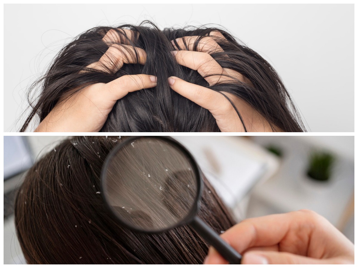 Sering Disamakan, Ini Perbedaan Ketombe dan Dermatitis Seboroik yang Perlu Diketahui