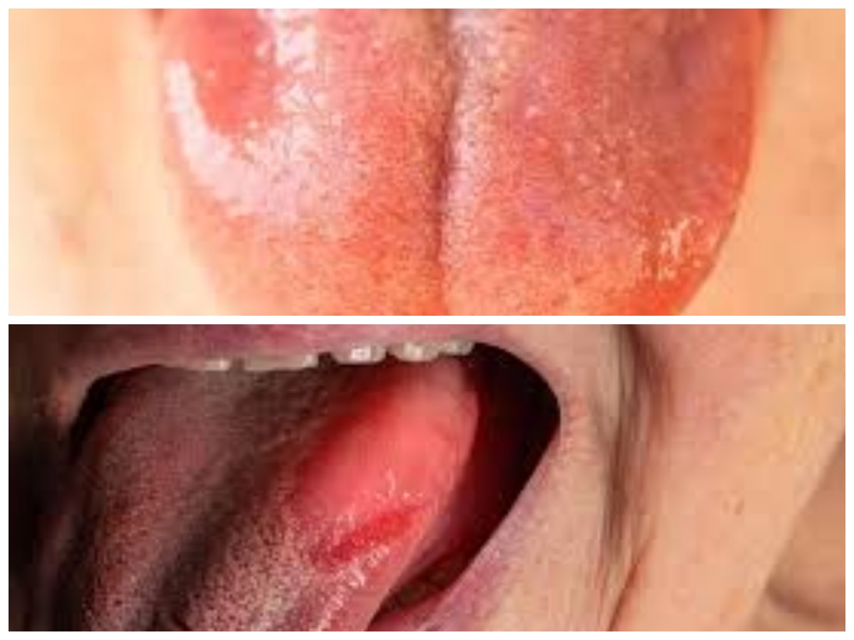 8 Cara Ampuh Redakan Radang Lidah Secara Alami dan Cepat