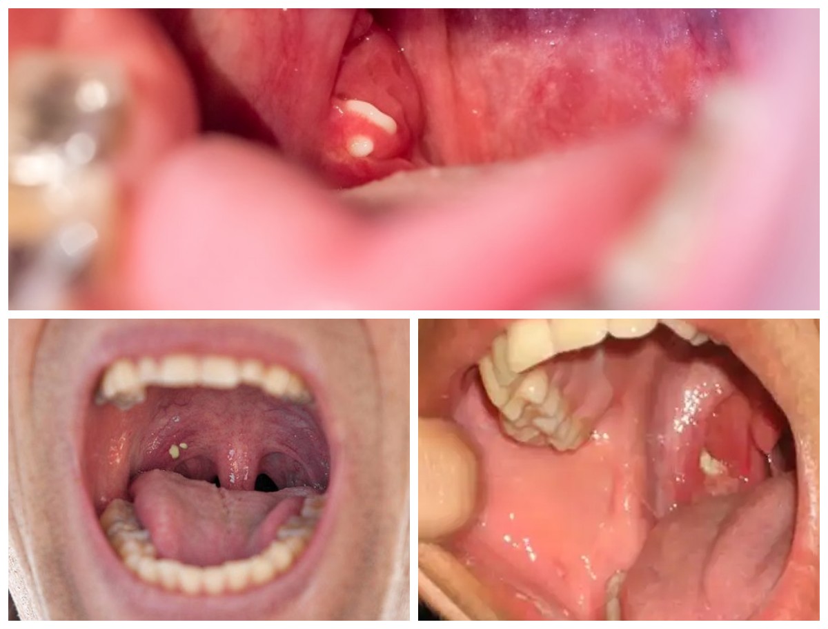 Kecil Tapi Mengganggu: Inilah 6 Penyebab Batu Amandel yang Perlu Kamu Tahu!