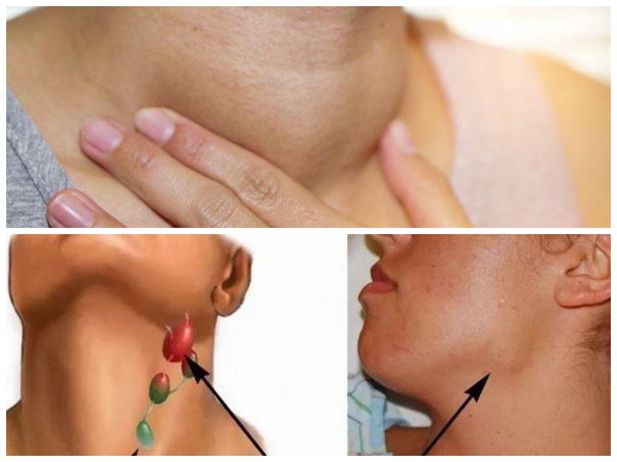 Cara Mengatasi Pembengkakan Kelenjar Getah Bening dengan Cepat dan Efektif