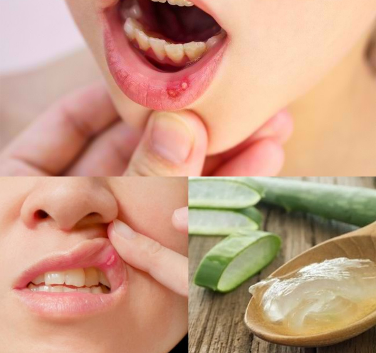 Ini Bahan Alami yang Mudah Didapat untuk Obat Sariawan!