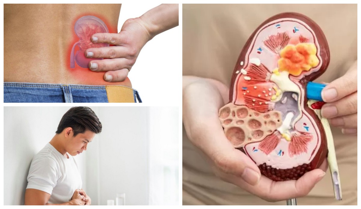 Tanda Awal Penyakit Ginjal yang Sering Terabaikan: Kenali Gejalanya Sebelum Terlambat