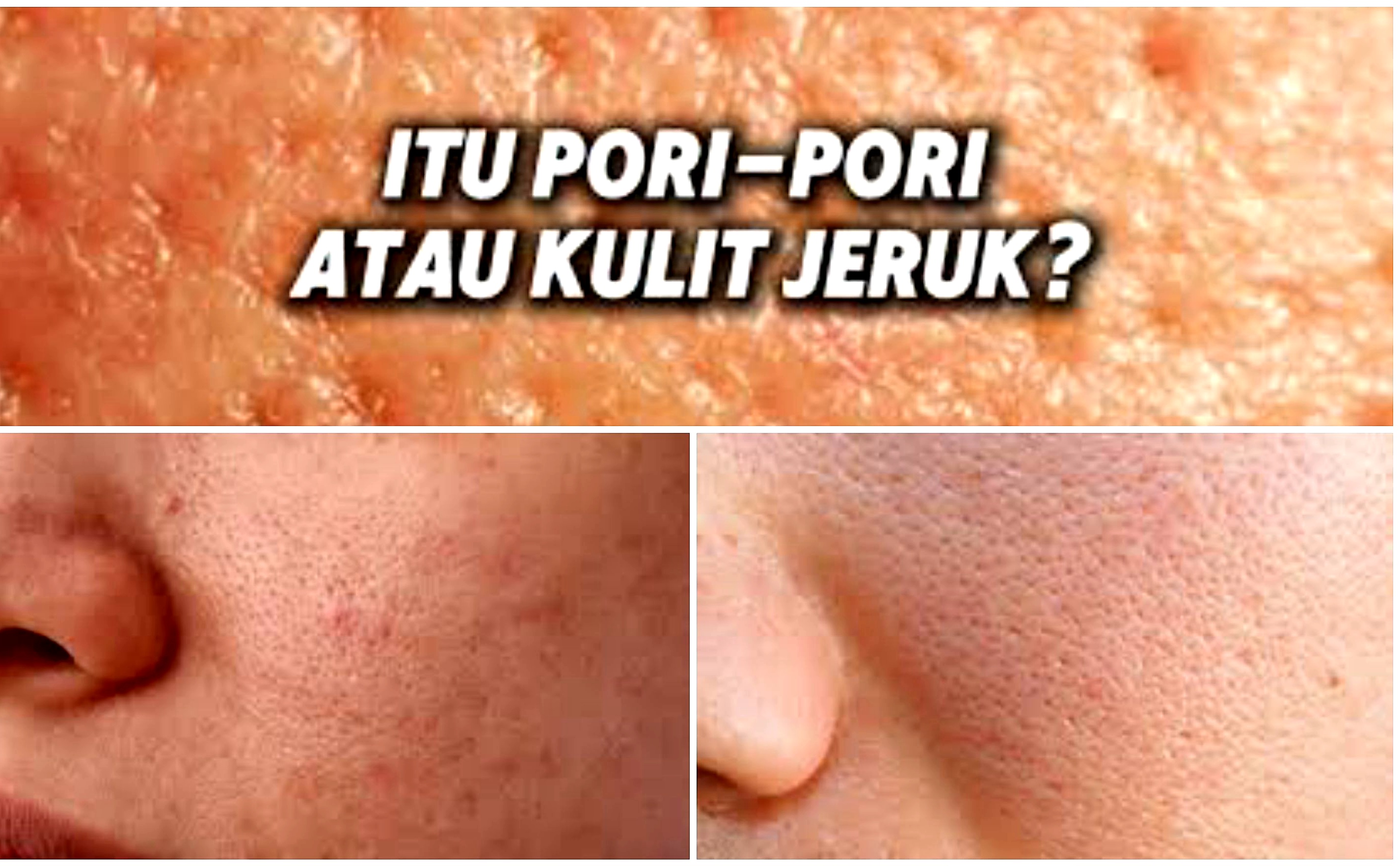 Untuk Kamu yang Berpori-pori Besar. Ini Cara Mengatasinya