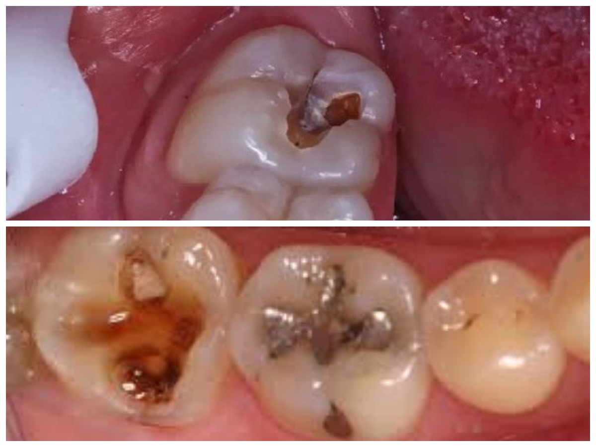 Rahasia Mengembalikan Kesehatan Gigi Berlubang dengan Bahan Alami di Rumah!