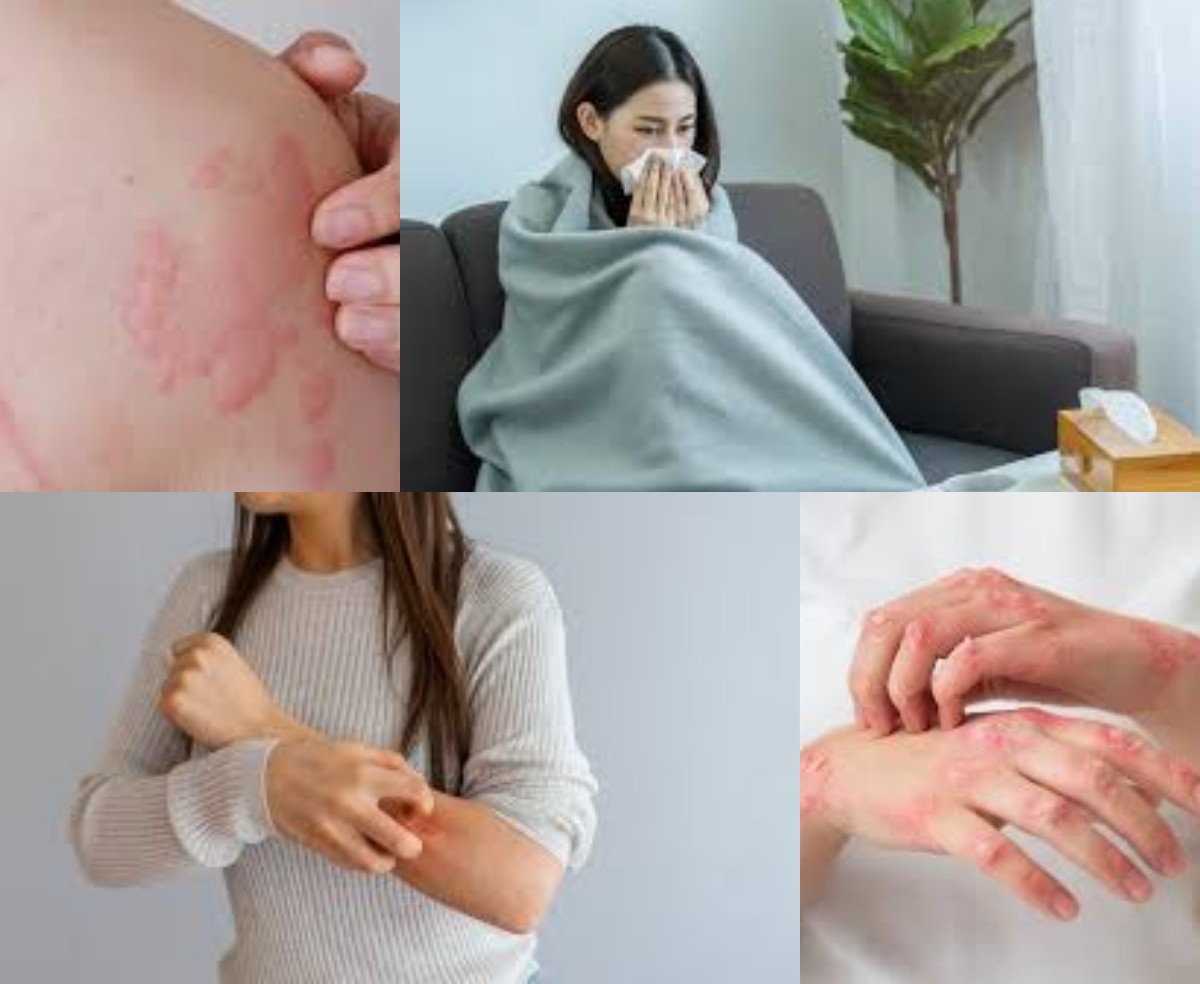 Sering Gatal atau Ruam Saat Cuaca Dingin? Waspadai Alergi Dingin dan Cara Mengobatinya