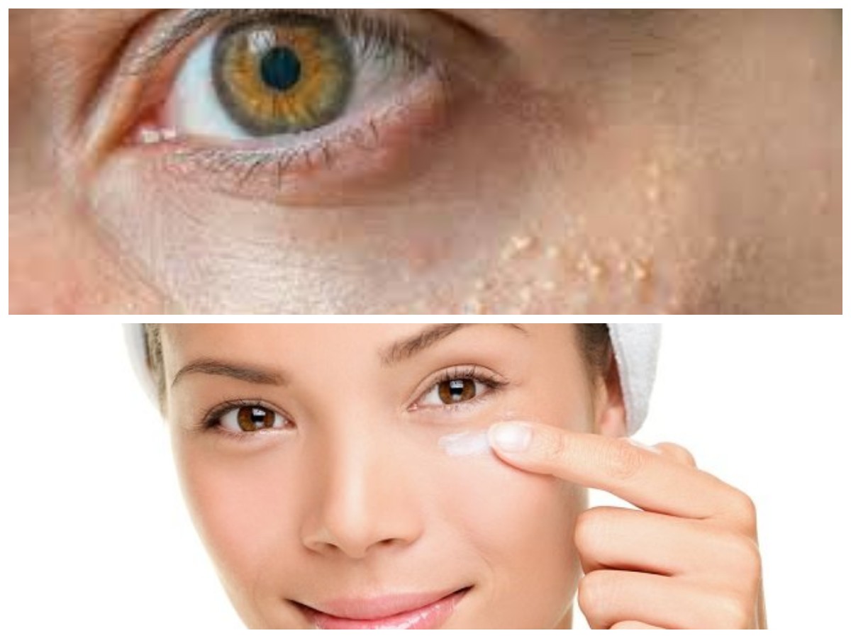 Solusi Alami Atasi Bintik Putih di Bawah Mata: Praktis dan Aman