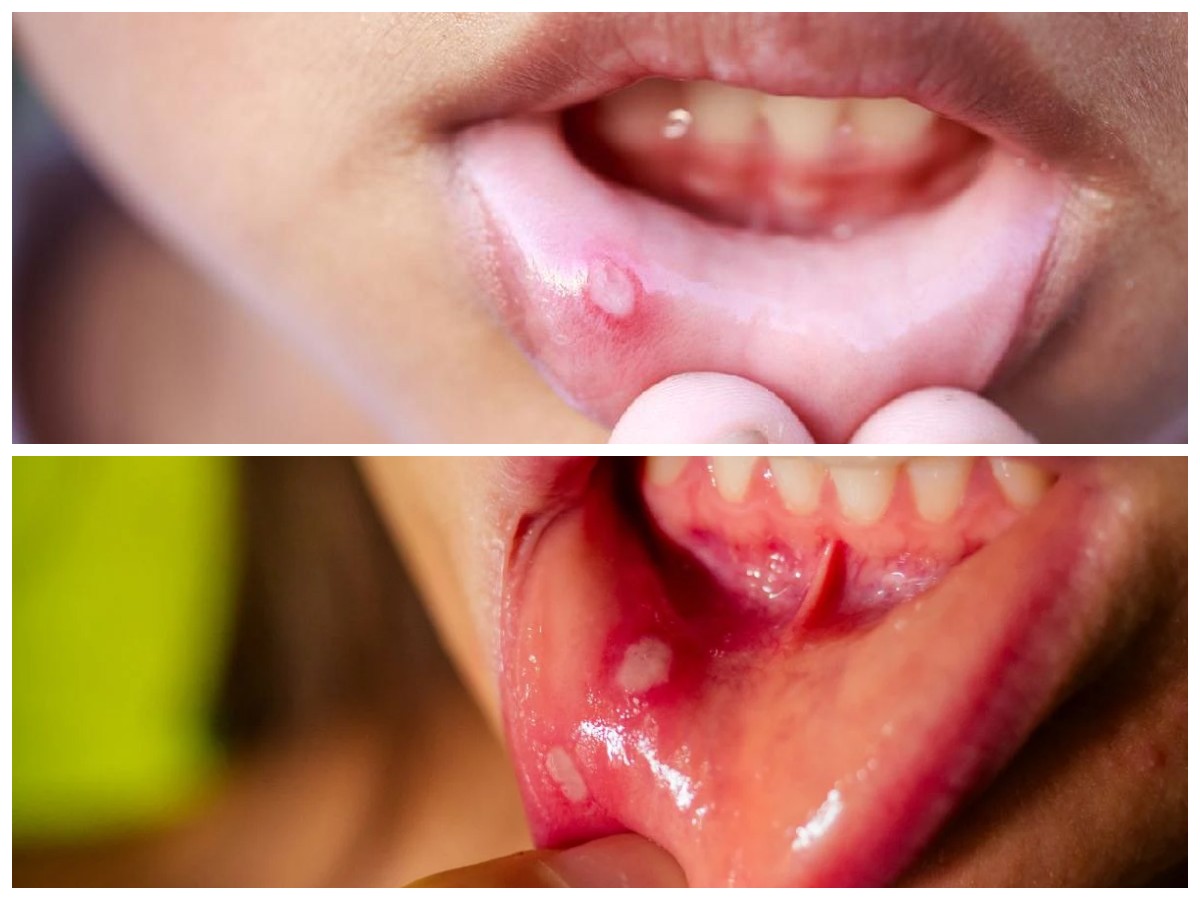 Mengenal Penyebab Sariawan yang Sering Terlewat dan Cara Ampuh Mengatasinya