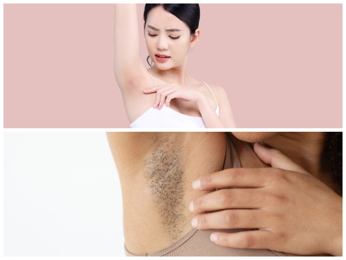 Cara Efektif Hilangkan Ketiak Hitam: Rangkaian Perawatan Alami hingga Medis yang Wajib Dicoba!