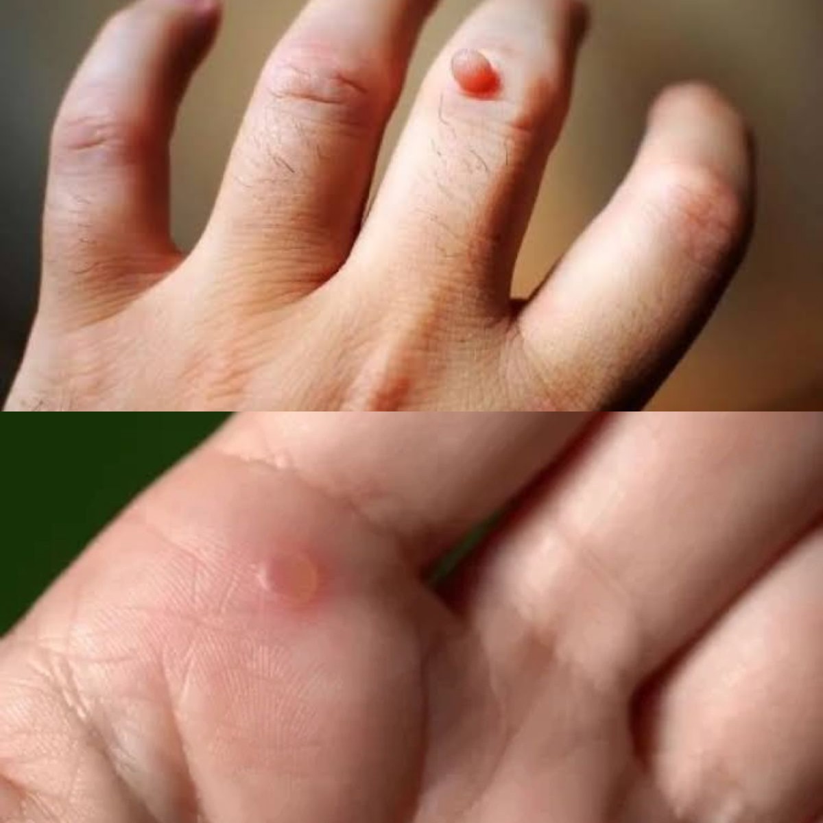 Tips Menghilangkan Penyakit Mata Ikan di Tangan Secara Aman Tanpa Takut Infeksi Kambuh Lagi!