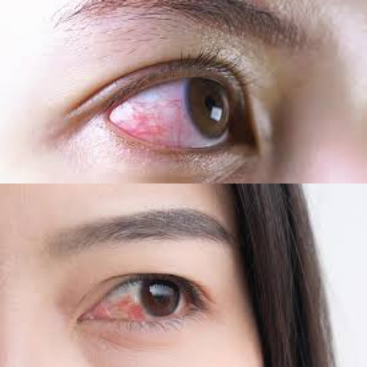 Begini 7 Metode Efektif untuk Menangani Mata Merah!