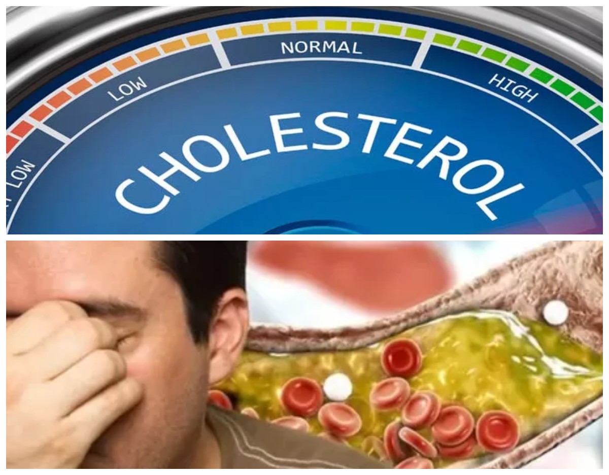 Bahaya Kolesterol Tinggi, Kenali 4 Penyakit yang Mengintai