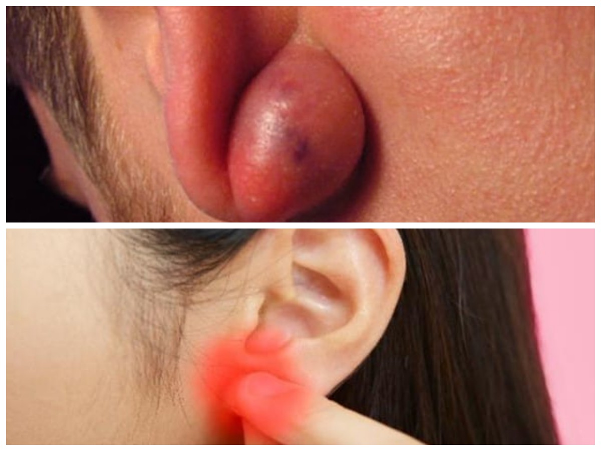 Sering Teraba Benjolan di Telinga? Ini Penjelasan dan Solusi Medisnya!