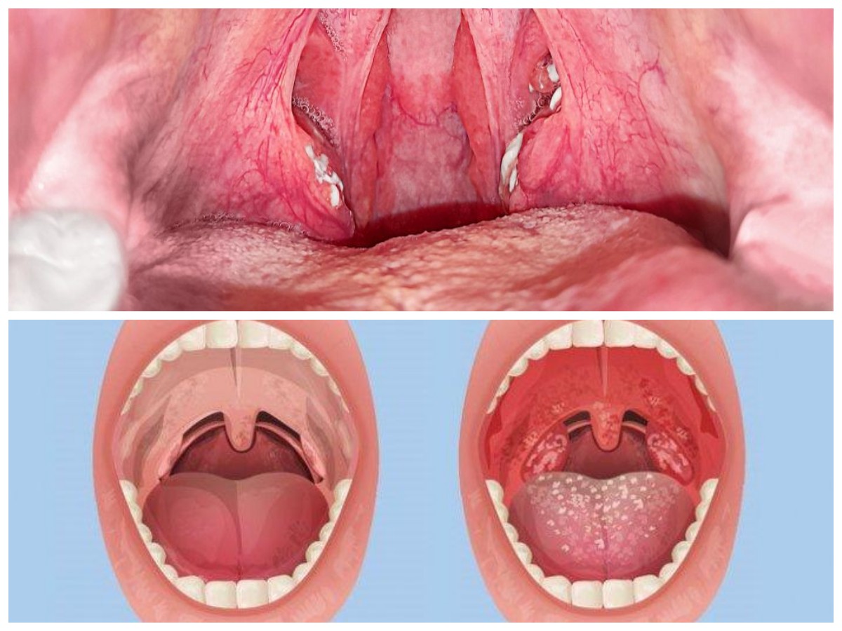 Sering Sakit Tenggorokan? Bisa Jadi Batu Amandel, Ini Tanda dan Solusinya!