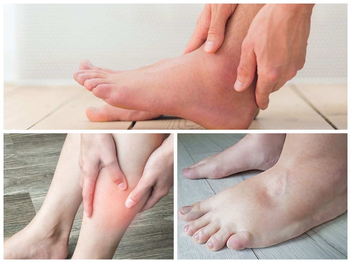 Kaki Bengkak: Kenali Penyebabnya dan Cara Efektif Menghilangkannya di Rumah!