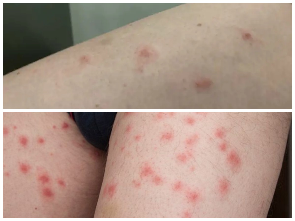 Tungau Kasur dan Risiko Kesehatannya: Cara Mendeteksi dan Mengatasi Gigitan