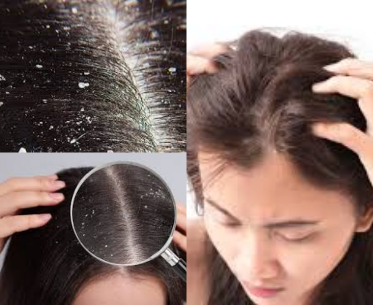 7 Cara Mudah dan Efektif untuk Mengatasi Ketombe Membandel