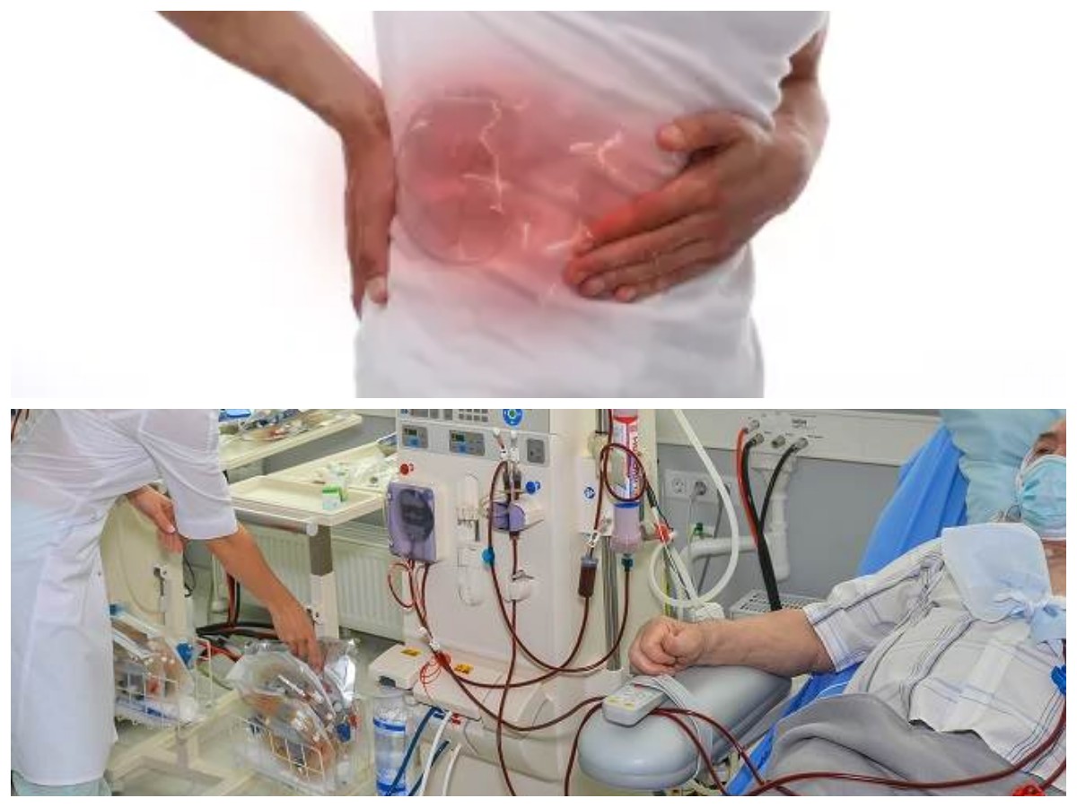 Panduan Mengatasi Penyakit Ginjal Stadium Awal Secara Efektif dan Aman