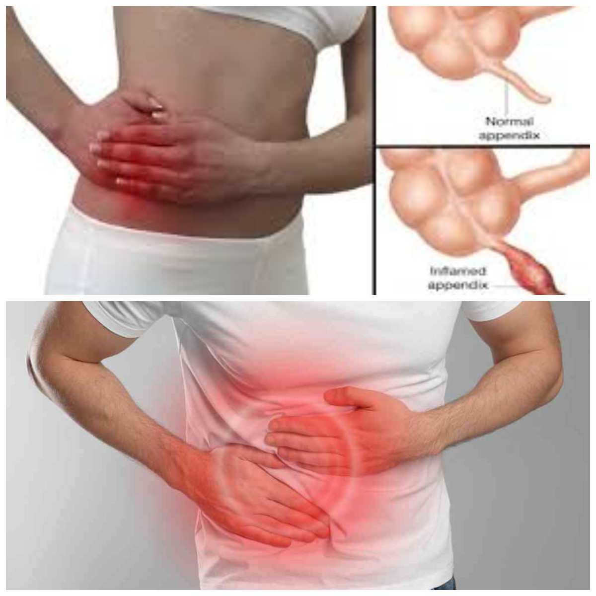 Wajib Tahu! Usus buntu biasanya diobati dengan operasi. 