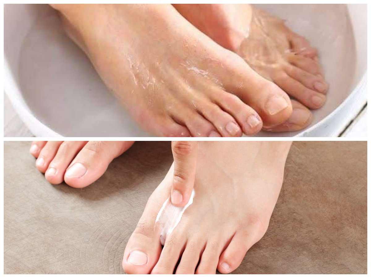 Cara Efektif Mengobati Kutu Air: Panduan Lengkap agar Cepat Sembuh dan Tidak Datang Lagi