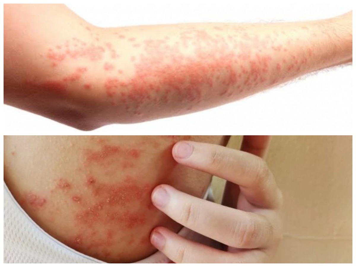 Wajib Tahu! 7 Jenis Penyakit Kulit Beserta Cara Mengatasinya Secara Tepat