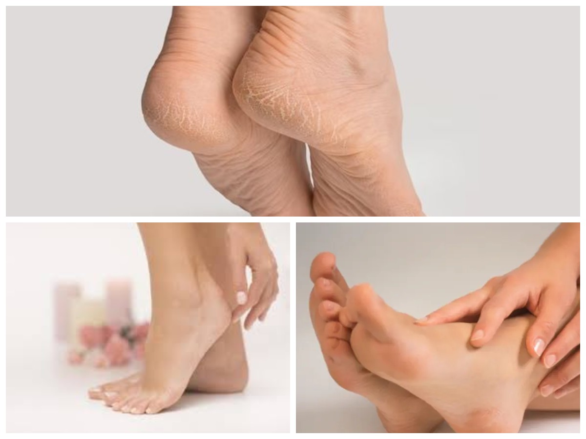 5 Tips Mengatasi Kaki Pecah-pecah serta Solusi Kulit Kaki Pecah-Pecah!