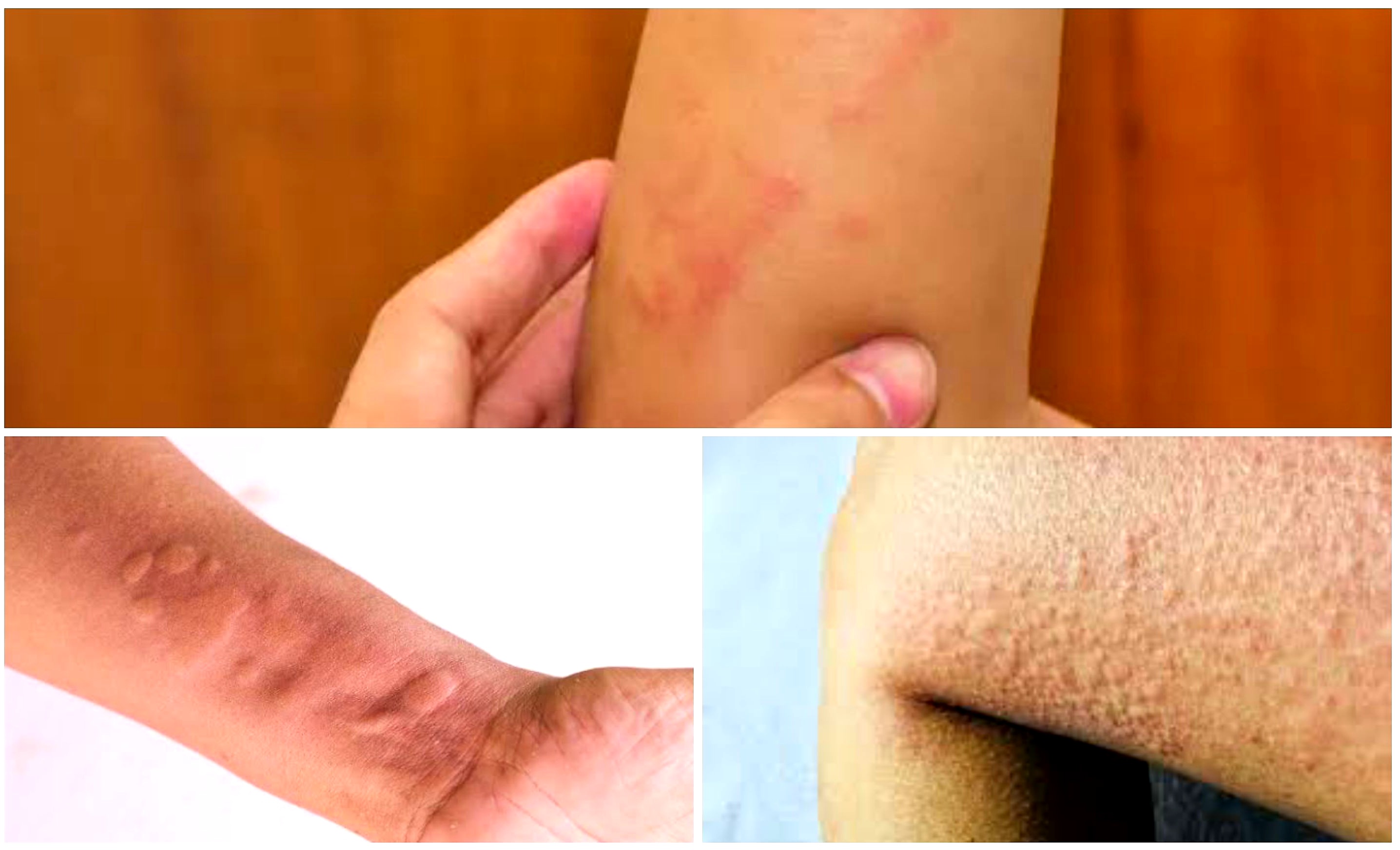 Kapan Harus Ke Dokter Saat Terkena Alergi Debu dan Dingin?