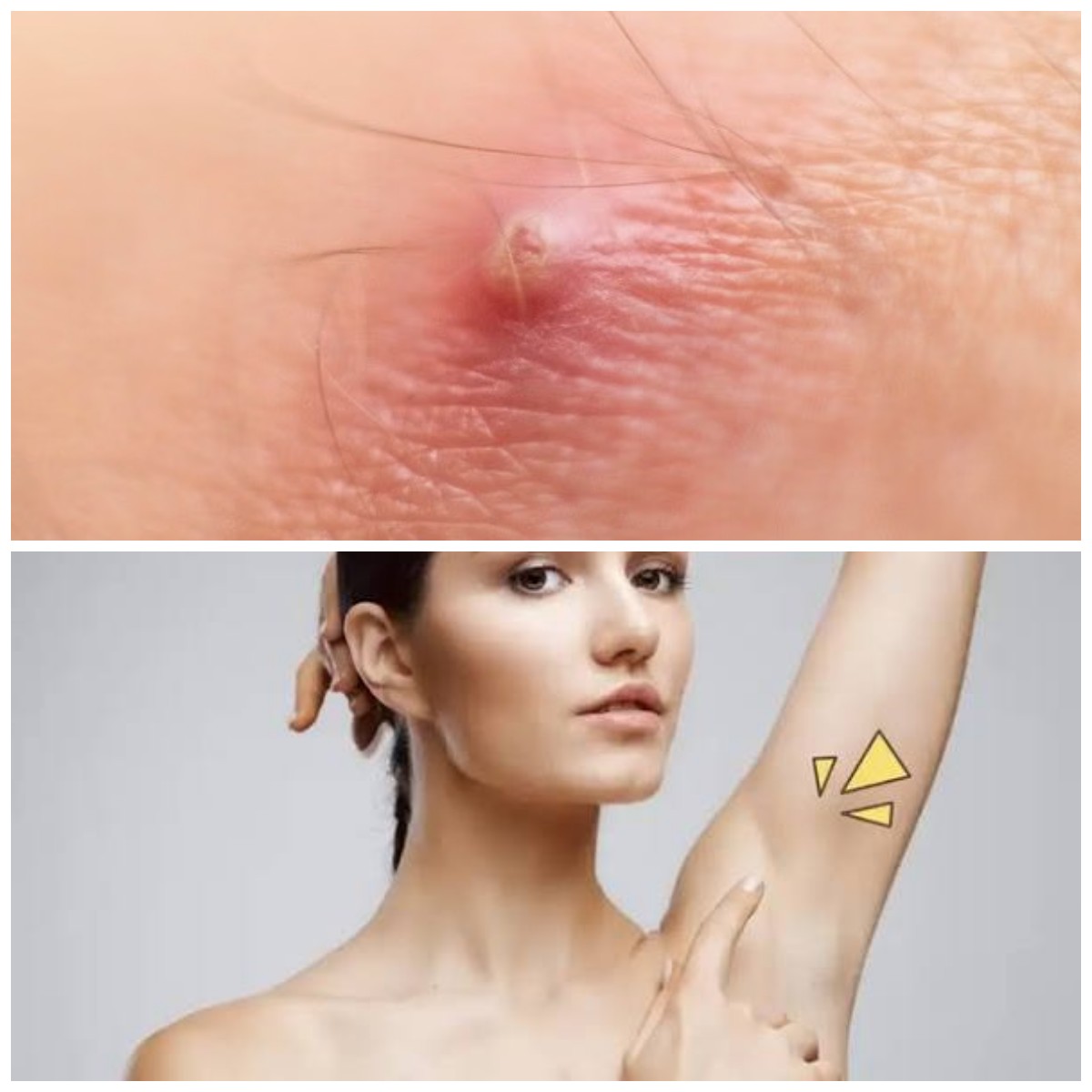Sangat Mengganggu Aktivitas, Ini Cara Ampuh Atasi Bisul di Ketiak Memanfaatkan Bahan Obat Rumahan!