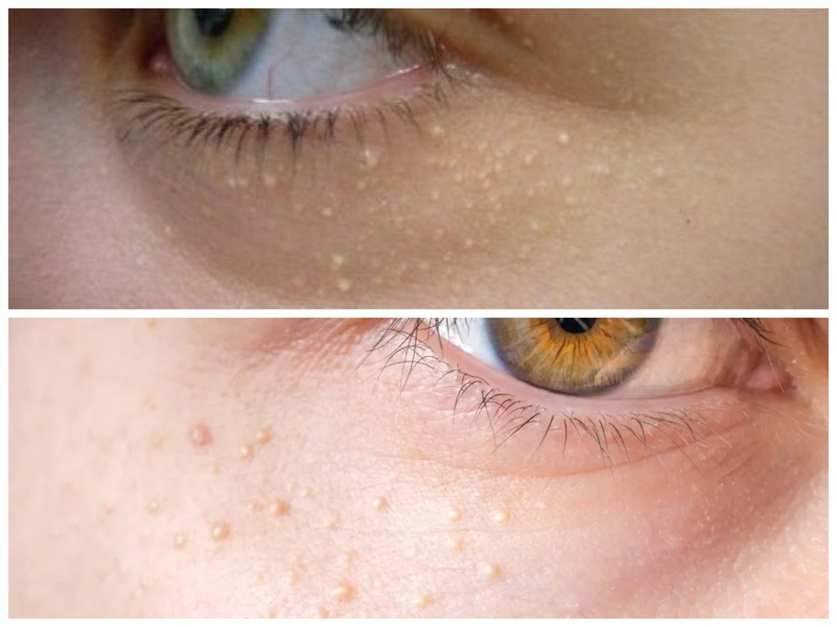 Bintik Putih di Sekitar Mata? Ini Cara Aman dan Efektif Mengatasinya